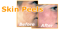 Skin Peels
